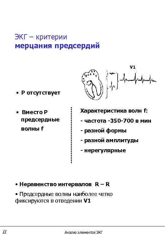 ЭКГ – критерии мерцания предсердий V 1 • Р отсутствует • Вместо Р предсердные