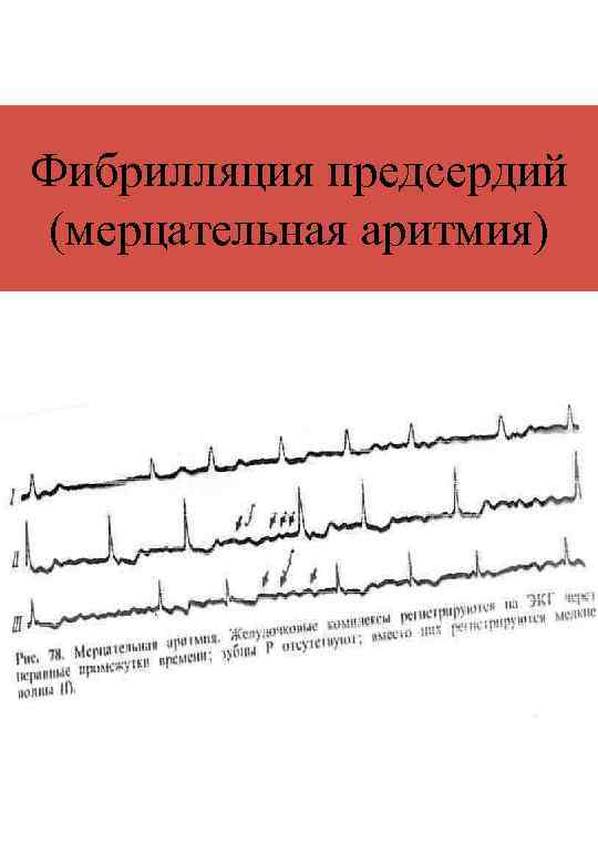 Фибрилляция предсердий (мерцательная аритмия) 
