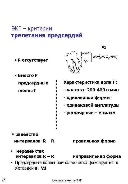 ЭКГ – критерии трепетания предсердий V 1 • Р отсутствует • Вместо Р предсердные