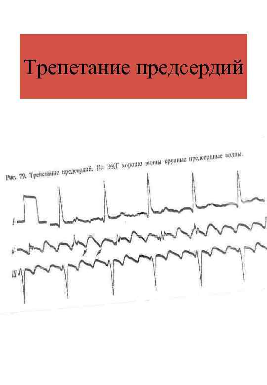 Трепетание предсердий 