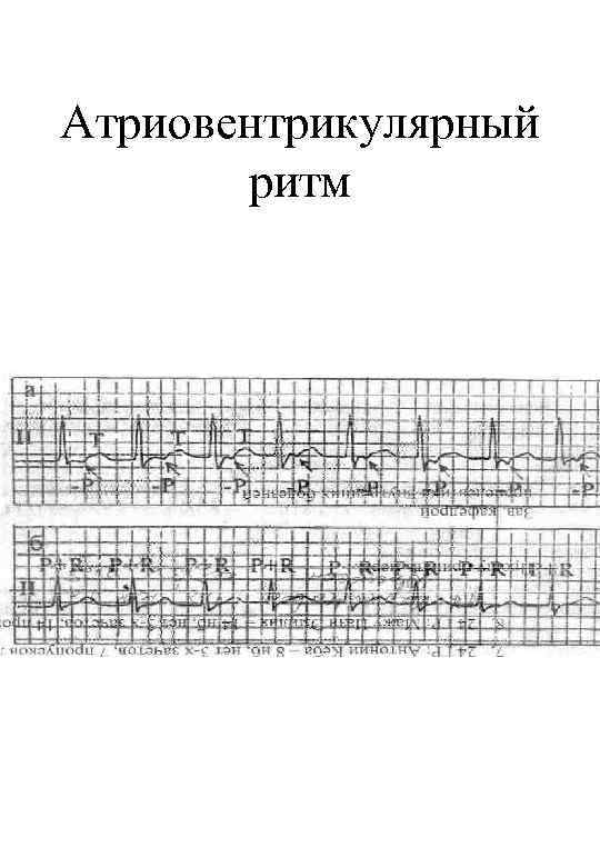 Атриовентрикулярный ритм 