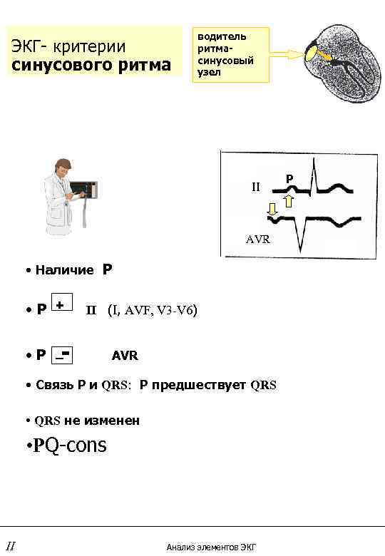 ЭКГ- критерии синусового ритма водитель ритмасинусовый узел II AVR • Наличие Р • Р