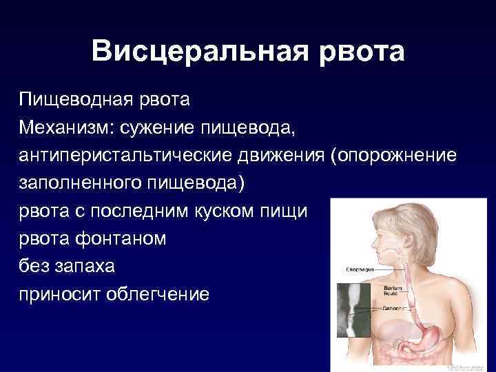 Висцеральная рвота Пищеводная рвота Механизм: сужение пищевода, антиперистальтические движения (опорожнение заполненного пищевода) рвота с