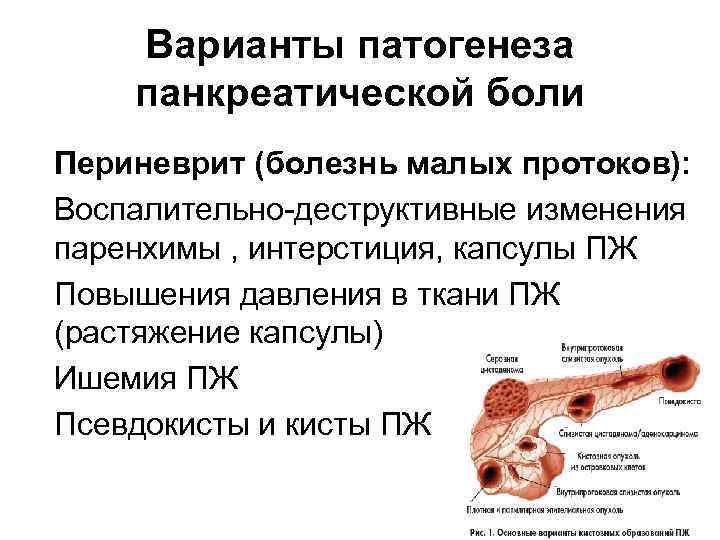 Варианты патогенеза панкреатической боли • Периневрит (болезнь малых протоков): • Воспалительно-деструктивные изменения паренхимы ,