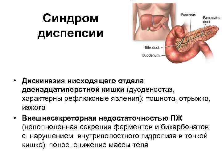 Синдром диспепсии • Дискинезия нисходящего отдела двенадцатиперстной кишки (дуоденостаз, характерны рефлюксные явления): тошнота, отрыжка,