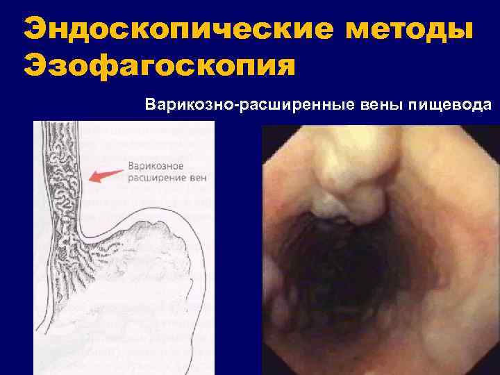 Эндоскопические методы Эзофагоскопия Варикозно-расширенные вены пищевода 