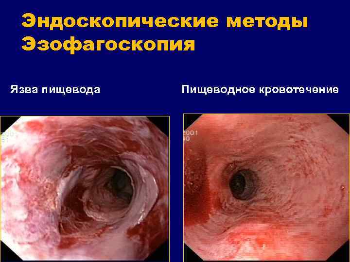 Эндоскопические методы Эзофагоскопия Язва пищевода Пищеводное кровотечение 