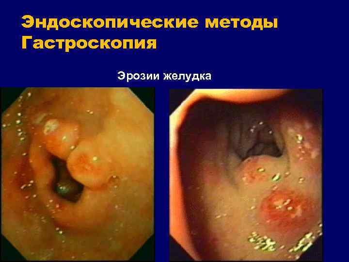 Эндоскопические методы Гастроскопия Эрозии желудка 