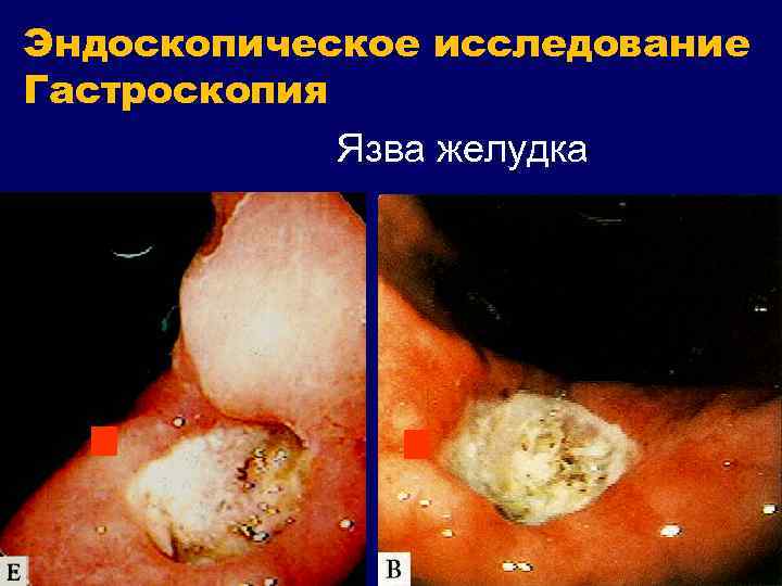Эндоскопическое исследование Гастроскопия Язва желудка 