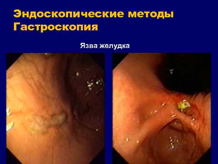 Эндоскопические методы Гастроскопия Язва желудка 