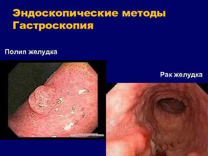 Эндоскопические методы Гастроскопия Полип желудка Рак желудка 