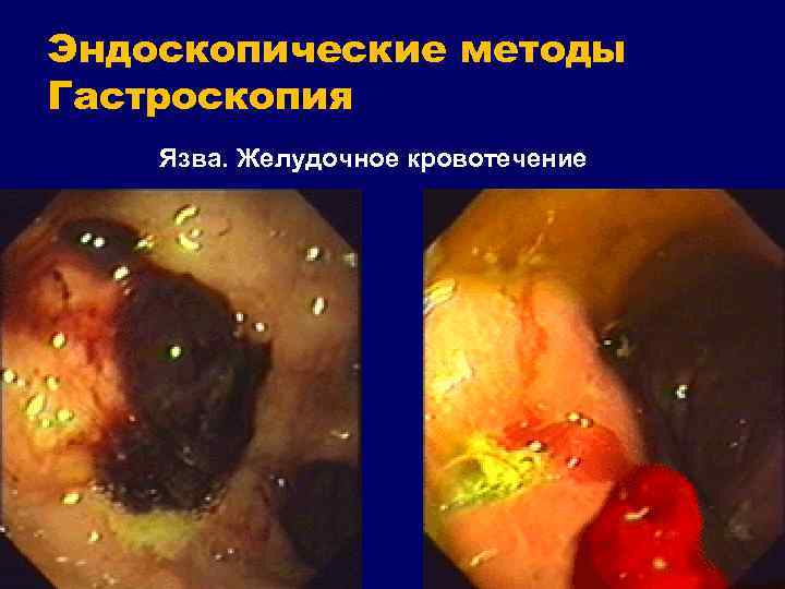 Эндоскопические методы Гастроскопия Язва. Желудочное кровотечение 