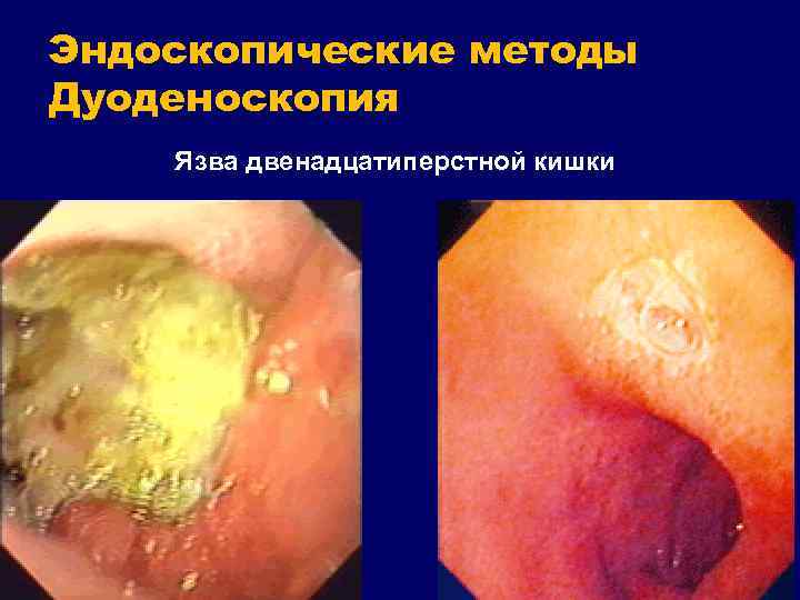 Эндоскопические методы Дуоденоскопия Язва двенадцатиперстной кишки 