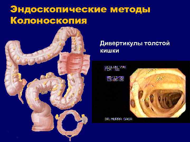 Эндоскопические методы Колоноскопия Дивертикулы толстой кишки 