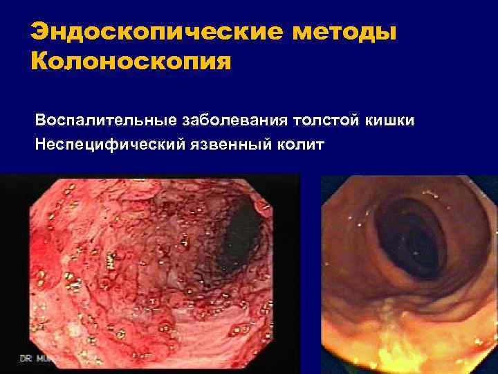 Эндоскопические методы Колоноскопия Воспалительные заболевания толстой кишки Неспецифический язвенный колит 