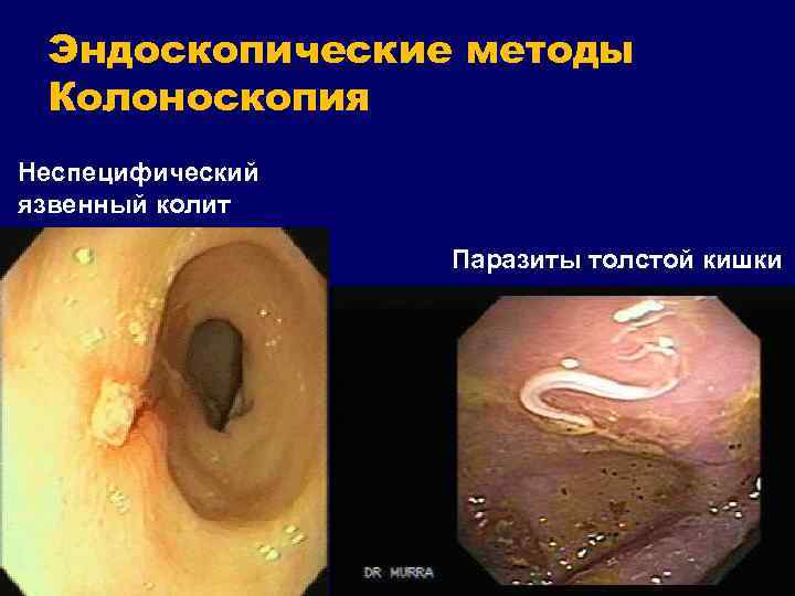 Эндоскопические методы Колоноскопия Неспецифический язвенный колит Паразиты толстой кишки 