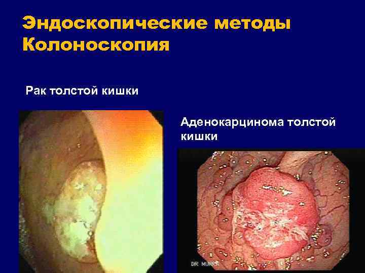 Эндоскопические методы Колоноскопия Рак толстой кишки Аденокарцинома толстой кишки 