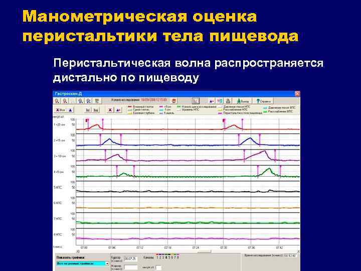 Манометрическая оценка перистальтики тела пищевода Перистальтическая волна распространяется дистально по пищеводу 