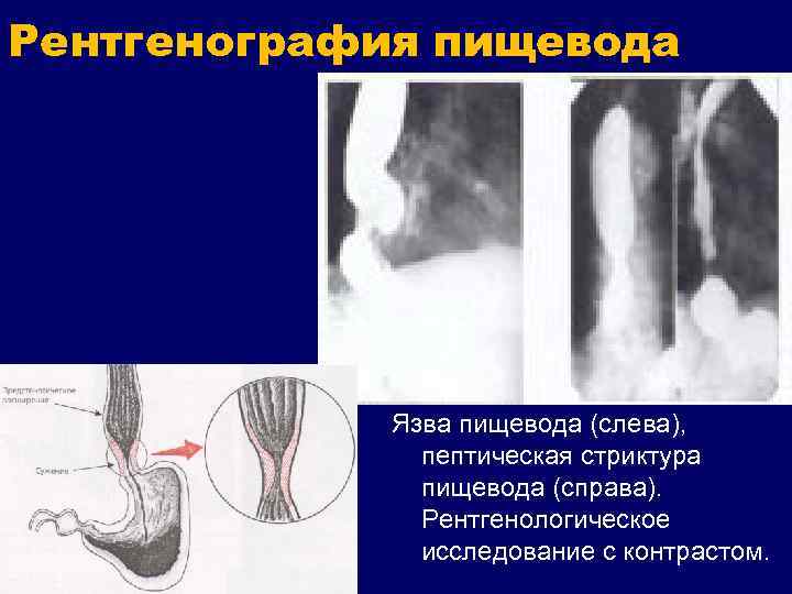 Рентгеноскопия пищевода