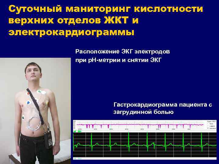 Схема расположения электродов экг