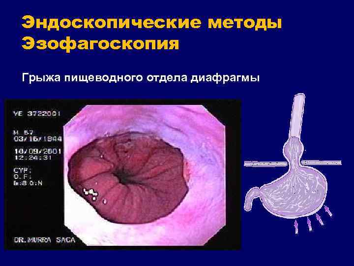 Эндоскопические методы Эзофагоскопия Грыжа пищеводного отдела диафрагмы 
