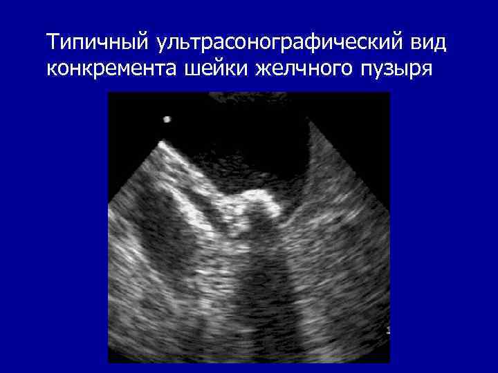 Типичный ультрасонографический вид конкремента шейки желчного пузыря 