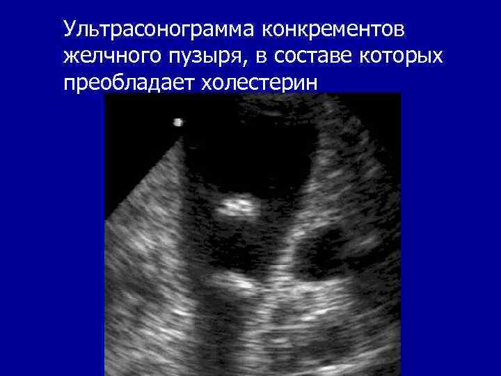 Ультрасонограмма конкрементов желчного пузыря, в составе которых преобладает холестерин 