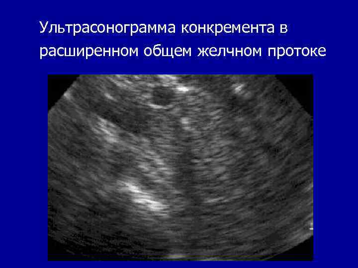 Ультрасонограмма конкремента в расширенном общем желчном протоке 