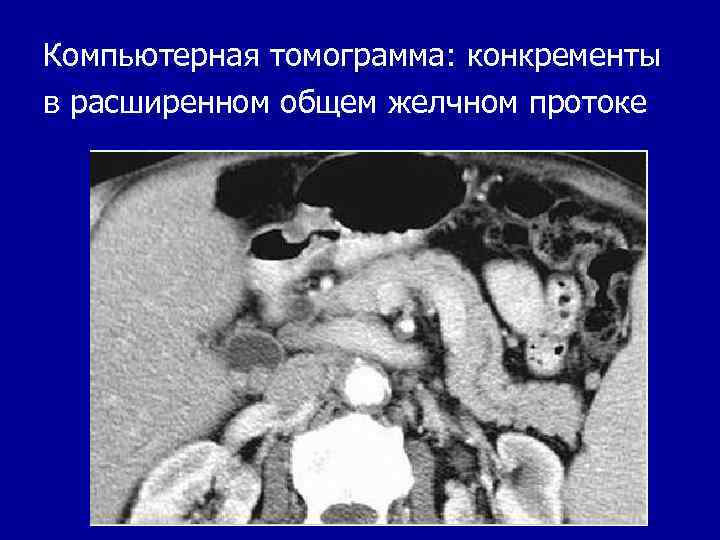 Компьютерная томограмма: конкременты в расширенном общем желчном протоке 