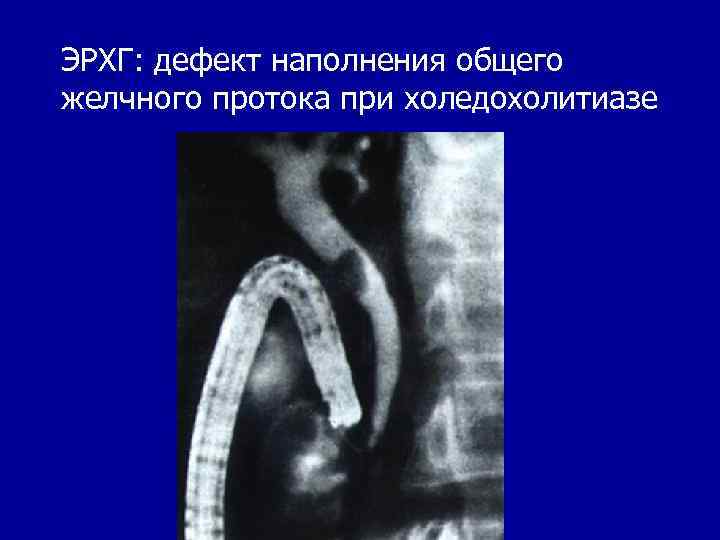 ЭРХГ: дефект наполнения общего желчного протока при холедохолитиазе 