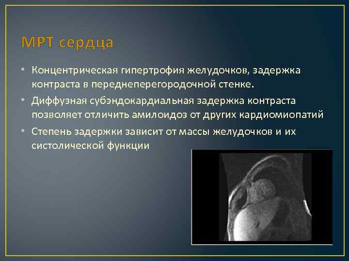 МРТ сердца • Концентрическая гипертрофия желудочков, задержка контраста в переднеперегородочной стенке. • Диффузная субэндокардиальная