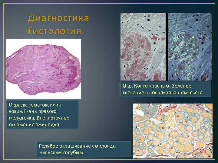 Диагностика Гистология Окр. Конго красным. Зеленое свечение в поляризованном свете Окраска гематоксилинэозин. Ткань правого