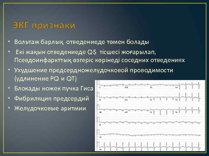 ЭКГ признаки • Вольтаж барлық отведениеде төмен болады • Екі жақын отведениеде QS тісшесі