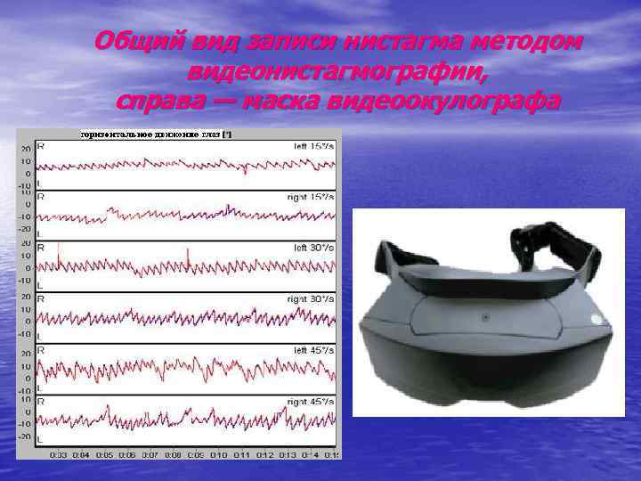 Общий вид записи нистагма методом видеонистагмографии, справа — маска видеоокулографа 