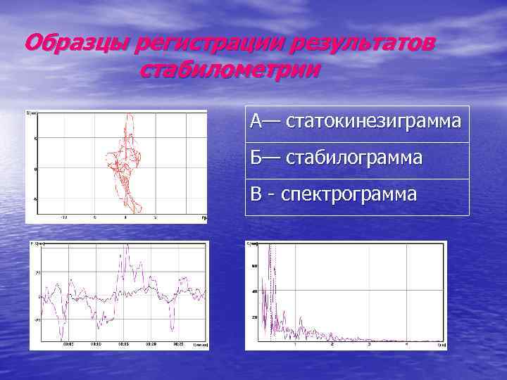 Образцы регистрации результатов стабилометрии А— статокинезиграмма Б— стабилограмма В - спектрограмма 