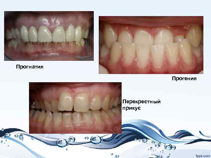 Прогнатия Прогения Перекрестный прикус 