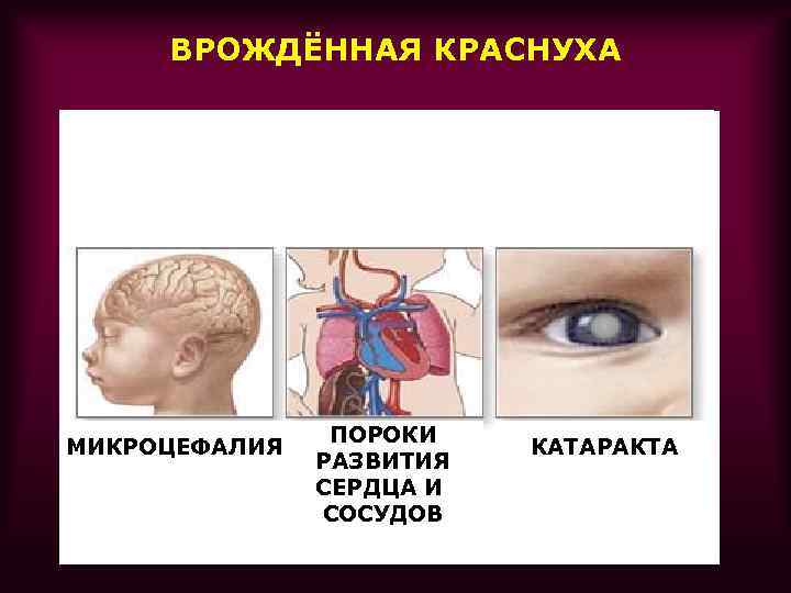 ВРОЖДЁННАЯ КРАСНУХА МИКРОЦЕФАЛИЯ ПОРОКИ РАЗВИТИЯ СЕРДЦА И СОСУДОВ КАТАРАКТА 