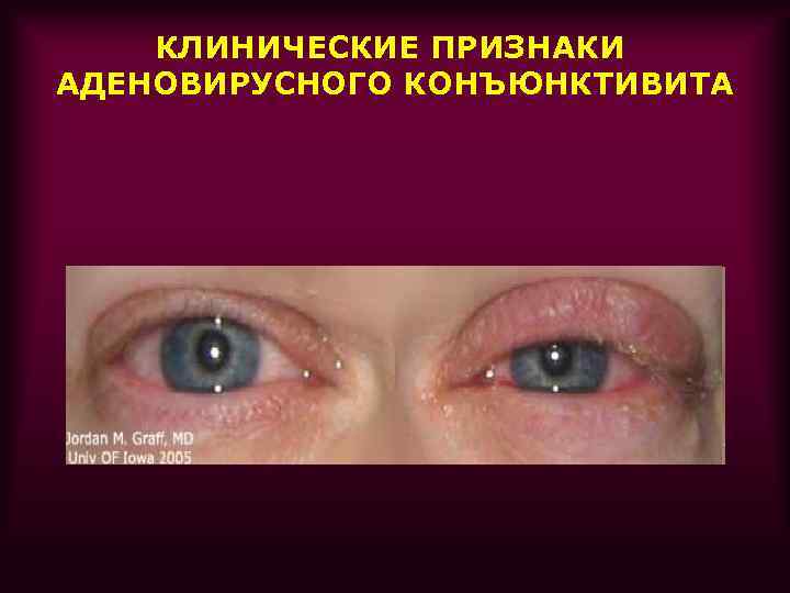 КЛИНИЧЕСКИЕ ПРИЗНАКИ АДЕНОВИРУСНОГО КОНЪЮНКТИВИТА 