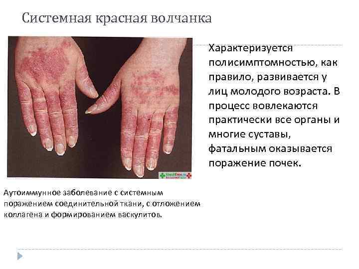Системная красная волчанка Характеризуется полисимптомностью, как правило, развивается у лиц молодого возраста. В процесс