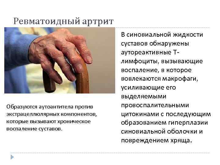 Ревматоидный артрит Образуются аутоантитела против экстрацеллюлярных компонентов, которые вызывают хроническое воспаление суставов. В синовиальной