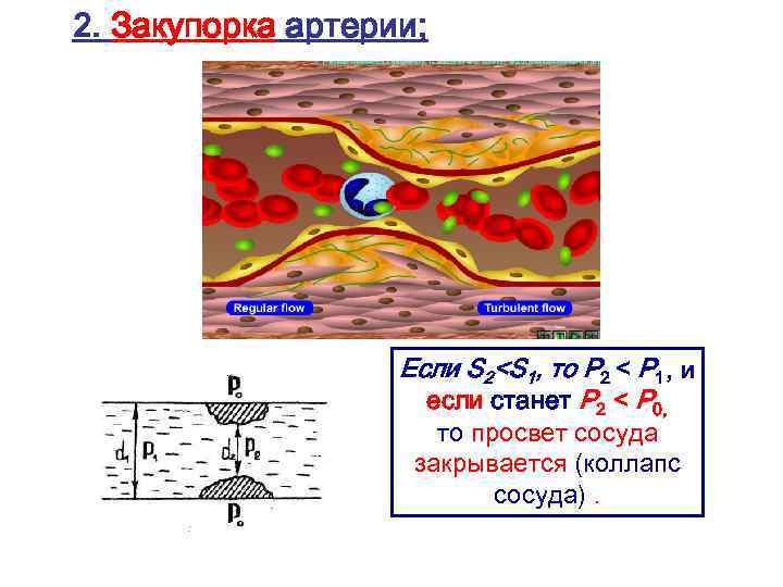 2. Закупорка артерии; Если S 2<S 1, то Р 2 < Р 1, и