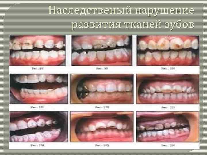 Наследственый нарушение развития тканей зубов 