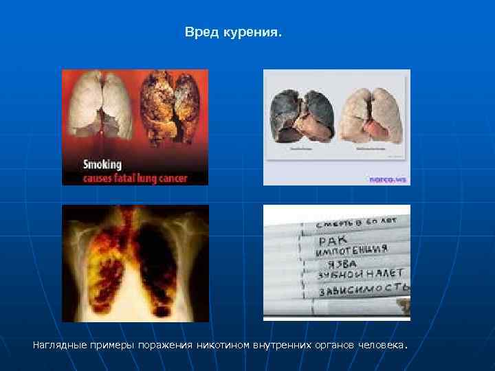 Вред курения. Наглядные примеры поражения никотином внутренних органов человека. 