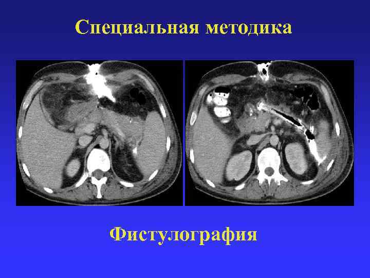 Специальная методика Фистулография 