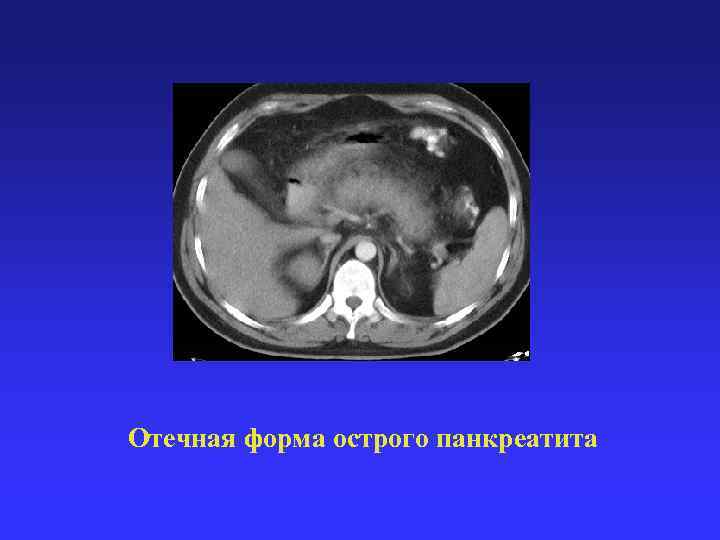 Отечная форма острого панкреатита 