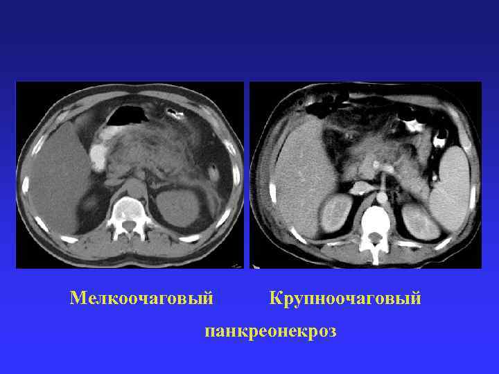 Мелкоочаговый Крупноочаговый панкреонекроз 