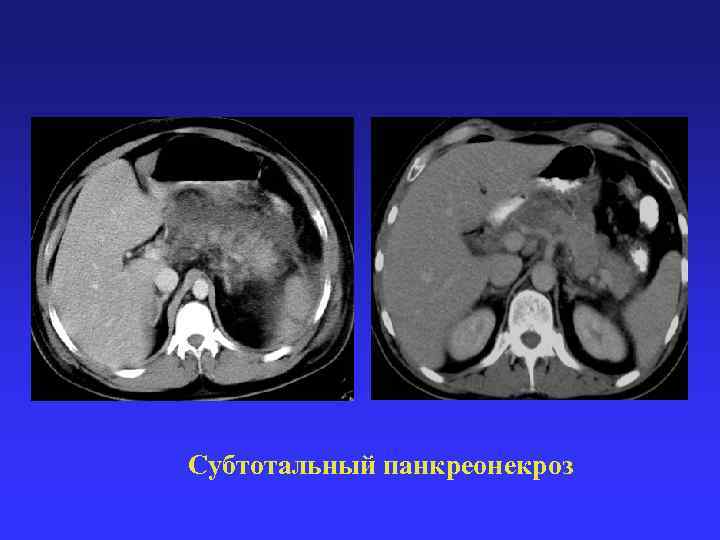 Субтотальный панкреонекроз 