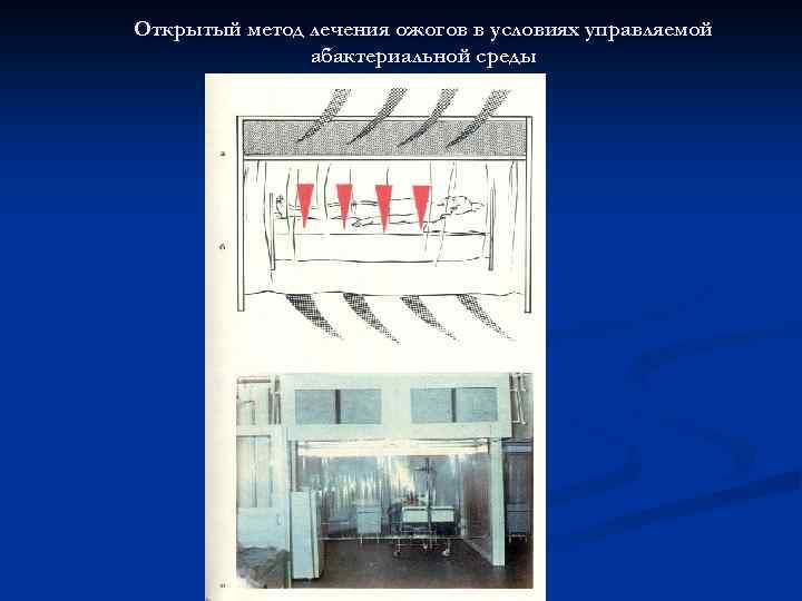 Открытый метод лечения ожогов в условиях управляемой абактериальной среды 