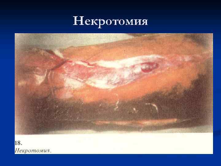 Некротомия 