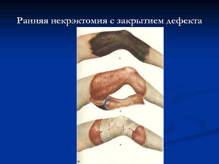 Ранняя некрэктомия с закрытием дефекта 